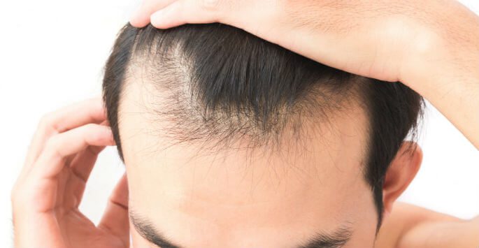 hair regrowth 2